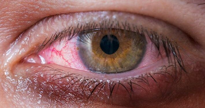 Consumo de drogas impacta negativamente a la salud visual: Medical Dimegar