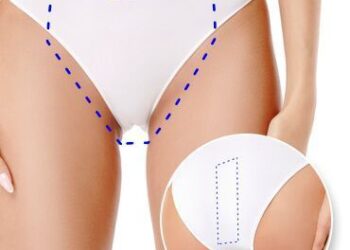 El Láser YAG Candela de Kopay: tecnología avanzada que supera a la microdermoabrasión y al láser diodo