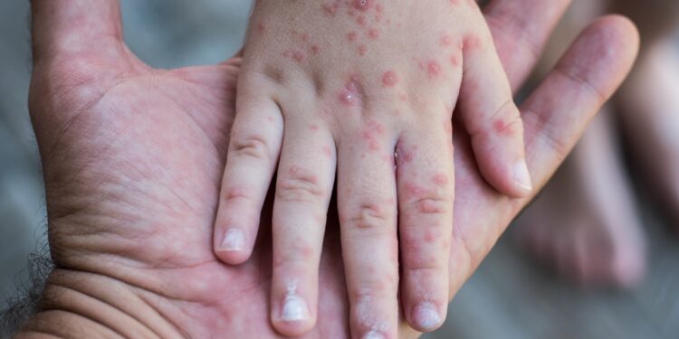 Brote de Coxsackie en primaria de Puebla: niños en aislamiento
