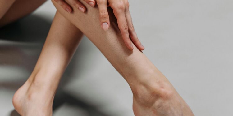 La insuficiencia venosa crónica en México representa un desafío para la salud pública