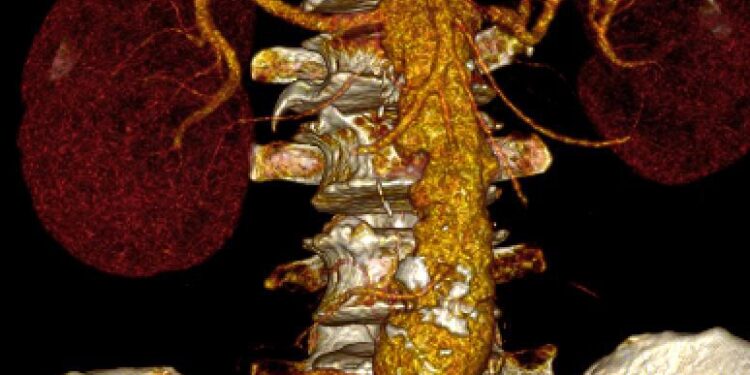 Histórica cirugía aórtica posiciona al ISSSTE de Mérida como referente médico